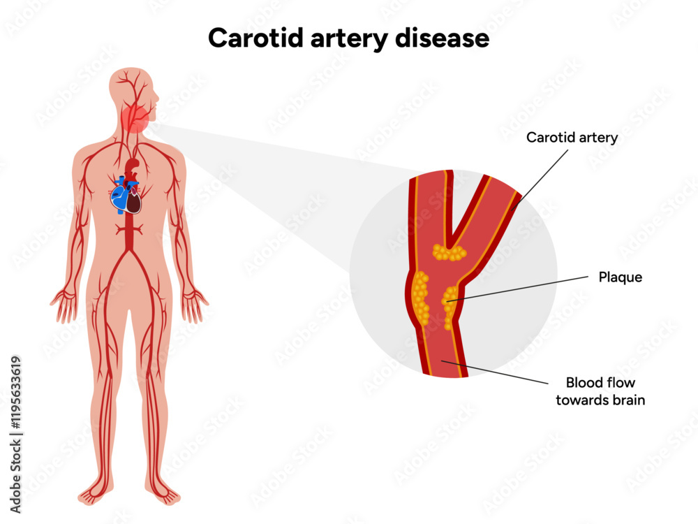 Carotid artery disease Signs of Carotid Artery Disease medical ...