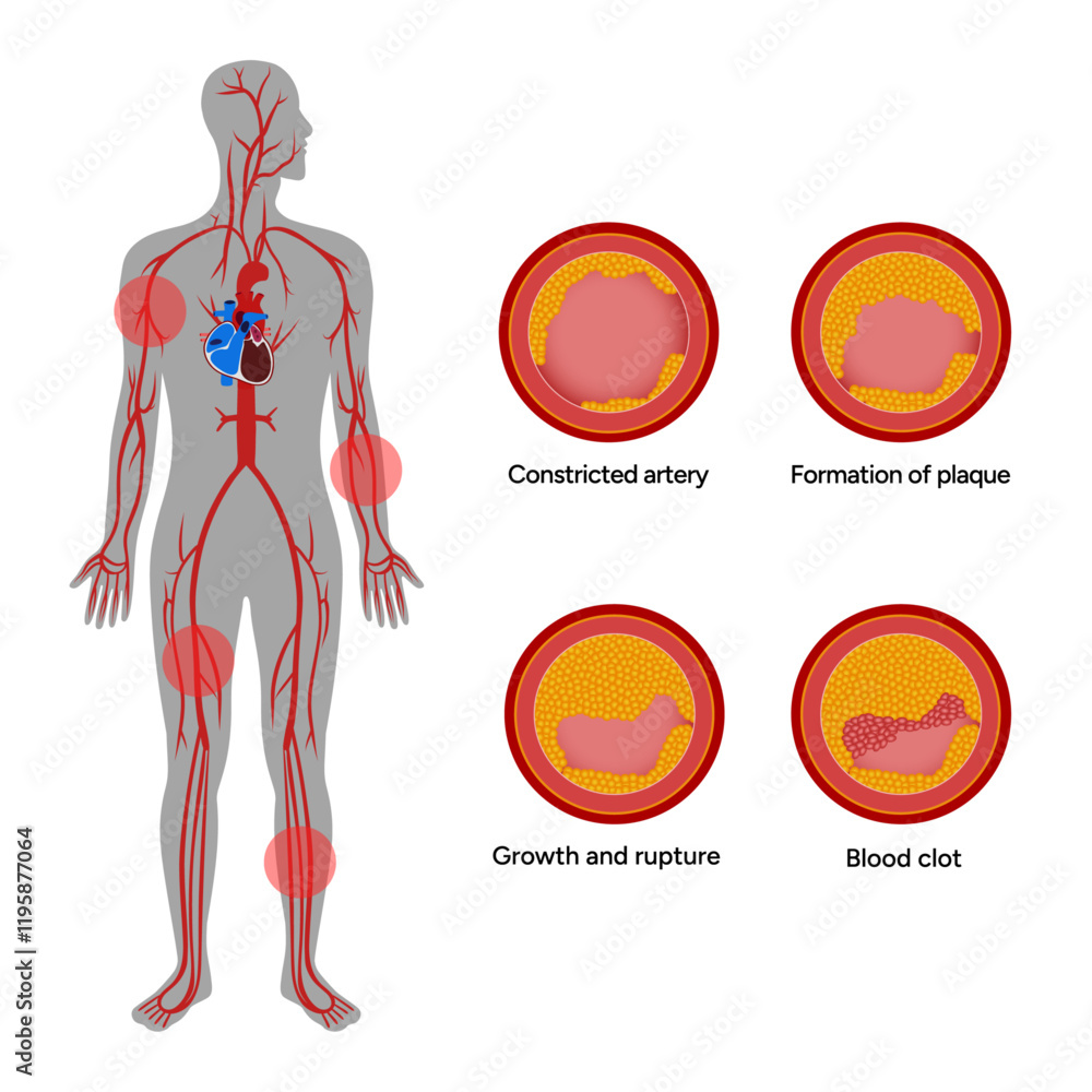 Carotid artery disease Signs of Carotid Artery Disease medical ...