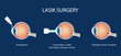 © natallia - The process of laser eye surgery LASIK. Vision correction for nearsightedness, farsightedness, and astigmatism