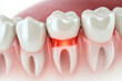 © Macrostock - Gum disease and inflammation from Periodontitis. 3D rendering.