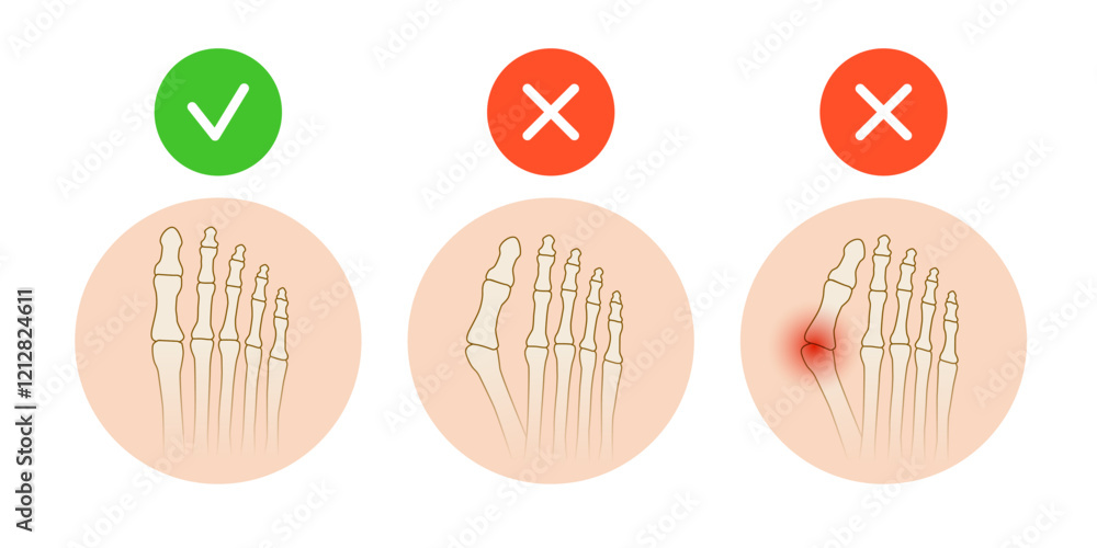 Hallux valgus. Valgus deformity of the big toe joint. Vector ...