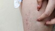 © Rung Kh - portrait the fingers holding the rash hives allergy and inflammation skin, reaction and urticaria, scar and scratch on the leg, irritation and disease, health care and medical concept.