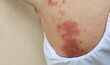 © Rung Kh - close up the rash hives allergy and inflammation skin, reaction and urticaria, allergic and irritation, infection and illness of a patient woman, health care and medical concept.