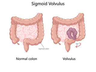 Wall Mural - Medical diagram comparing a normal colon with a sigmoid volvulus, twisting of the sigmoid colon causing obstruction hand drawn schematic vector illustration. Medical science educational illustration