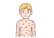 © sopon - Child with Measles Rash: Illustration of a young boy with a visible measles rash, showcasing the characteristic reddish spots across his torso and arms.  The illustration is done in a simple.