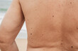 © Anastasia - The back of an elderly man with freckles, aging spots, black, brown warts and wrinkles.