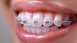 © Prostock-studio - Close up view of a smile with metal braces, showcasing the brackets and wires that help in aligning teeth, enhancing confidence and dental health over time.