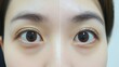 © Color Forge - Eye Bags Before And After Cosmetic Treatment,