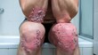© mediastok.ai - Severe Psoriasis:  A Close-Up Image of Psoriatic Lesions on a Man's Knees