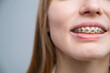 © Михаил Решетников - Close-up of a young woman's smile with metal braces on her teeth. Correction of bite