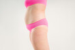 © staras - Tummy tuck, flabby skin with stretch marks on a fat belly, plastic surgery concept on light gray background