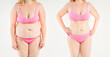 © staras - Tummy tuck, woman's fat body before and after weight loss and liposuction on gray background, plastic surgery concept