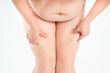 © staras - Overweight woman, fat thighs and legs, obesity female body with cellulite on gray background