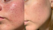 © Vikto - Macro photo of big pore on oily facial skin type. Skin with enlarged pores. Care for problem skin. Sun, natural light