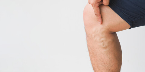 Man leg with varicose veins on white background.