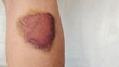 © Rung Kh - Woman with a pain, Swollen and bruised on the leg, health care and medical concept.