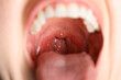 © New Africa - Closeup view of woman's oral cavity. Sore throat