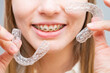 © Михаил Решетников - Woman with braces on her teeth holding and removable transparent aligners.