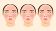 © Isabella - Types of Rosacea: Visual Guide to Symptoms and Treatment
