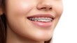 © Majri - Elegant Close-up of a teenage girl smiling, proudly showing her braces. Ideal for dental care, orthodontics, youth, smiles, and teen health related promotions.