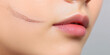 © Lila Patel - Close-up of Facial Scar and Lip