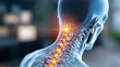 © Arfuu - image shows X ray depiction of severe spinal injury with nerve compression, highlighting affected vertebrae in neck area