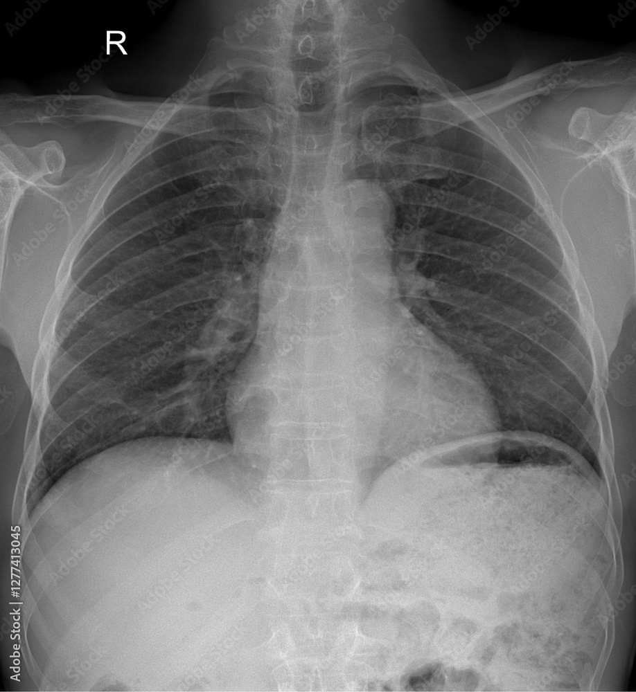 Real Human Chest Radiograph Image Stock Photo | Adobe Stock