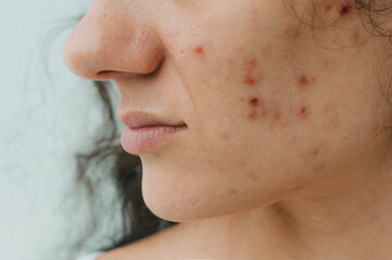 Close-up of a young woman with acne on her face and skin problems.