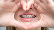 © Михаил Решетников - Caucasian woman in braces holding fingers in the shape of a heart.