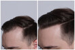© New Africa - Man with hair loss problem before and after treatment on light grey background, closeup. Collage of photos