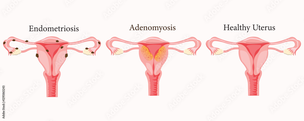 Medical Illustration Comparing Endometriosis Adenomyosis And A Medical Illustration Comparing Endometriosis Adenomyosis And A