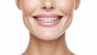 © timofeev - Close-up Metal Brackets on Teeth. Orthodontic Dental. Dental Care, Teeth Correction, Female Smile with Braces. Close-up of white teeth with braces. Dental care, treatment. Woman with tooth braces