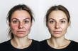 © id512 - Before and after comparison of a European woman with severe facial redness and skin imperfections, transformed into clear, flawless skin with skincare or cosmetic treatment