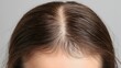 © thanarak - close up view of a parted scalp revealing a thinning hair pattern and reduced hair follicle density highlighting a potential hair loss or balding condition