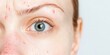 © Aleksandra - close-up of a woman with acne, pimples or scars, marks on skin. dermatology, медицинская справка.