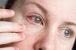 © TatjanaMeininger - Close up of female face with one red eye suffering from infection conjunctivitis