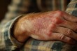 © Evhen Pylypchuk - A close-up of a red irritated patch on a person's arm showing skin irritation and discomfort.