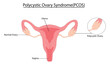 © izunna - Polycystic Ovary Syndrome (PCOS) vector illustration