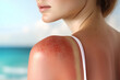 © Annamorphosis - A woman with sunburn on her back and shoulders