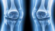 © Alea - Knee Joints Scan in Blue Light on Black Background