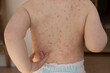 © ink drop - A young child with severe chicken pox illness covered in spots and blisters