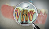 3D illustration of Endodontic root canal treatment. An advanced endodontic file is in action. It removes the infected enamel, dentin and some parts of the pulp tissue.