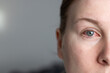© TatjanaMeininger - Close up of female face with one red eye suffering from infection conjunctivitis