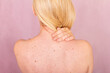 © ADDICTIVE STOCK - Skin health awareness highlighting back examination for cancer