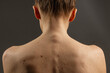 © st.kolesnikov - girl's back close-up with many moles, papillomas, treatment and removal of papillomas, skin care