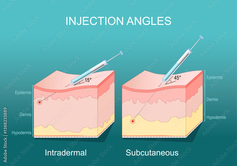 Injection technique. Needle angle. Cross section of human Skin layers ...