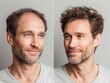© ai_katrin - realistic split-screen photo of a man before and after hair transplant