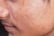 © Towfiqu Barbhuiya  - Close-up of skin with acne scars in natural light