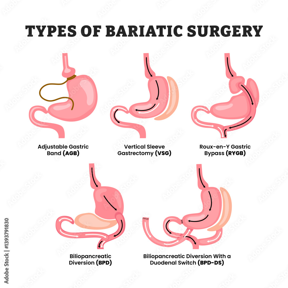 Bariatric 30 Compresse