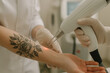 © Aleksandra - Professional laser tattoo removal procedure on arm in clinic setting